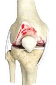 Knee Osteoarthritis