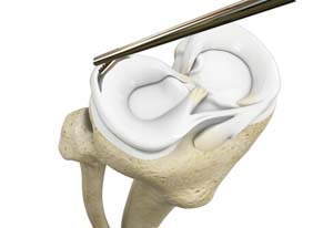 Partial Meniscectomy of Knee