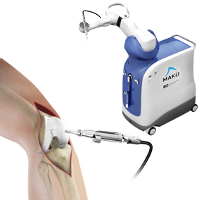 Robotic Assisted Partial Knee Replacement