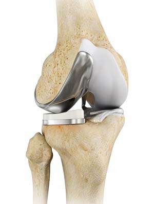 Knee Arthroscopy